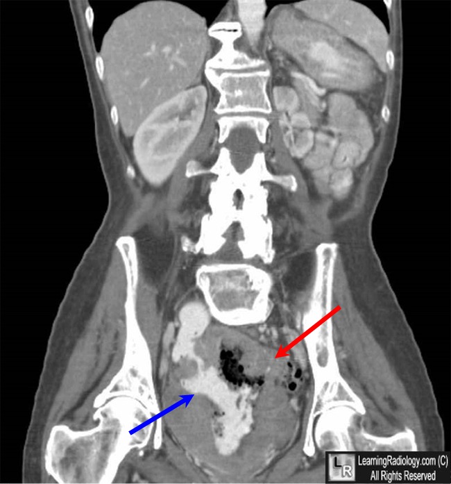 Small bowel lymphoma